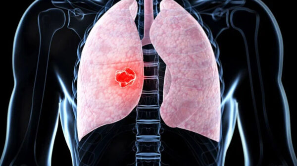 N Dulo Pulmonar Qu Es S Ntomas Recomendaciones Atenci N M D