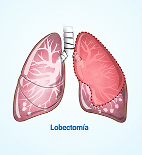 Lobectomía pulmonar
