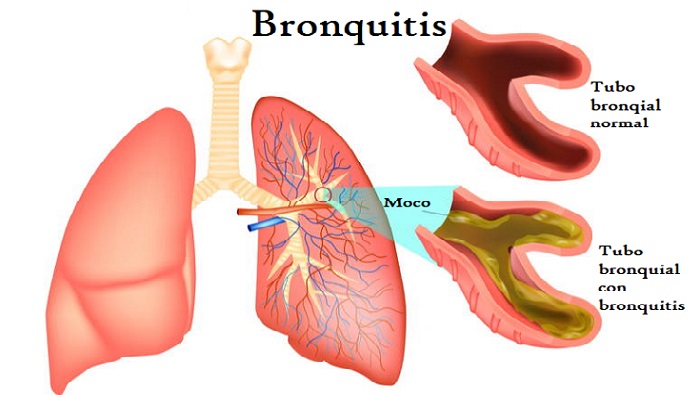 Bronquitis Qu Es S Ntomas Recomendaciones Atenci N M D